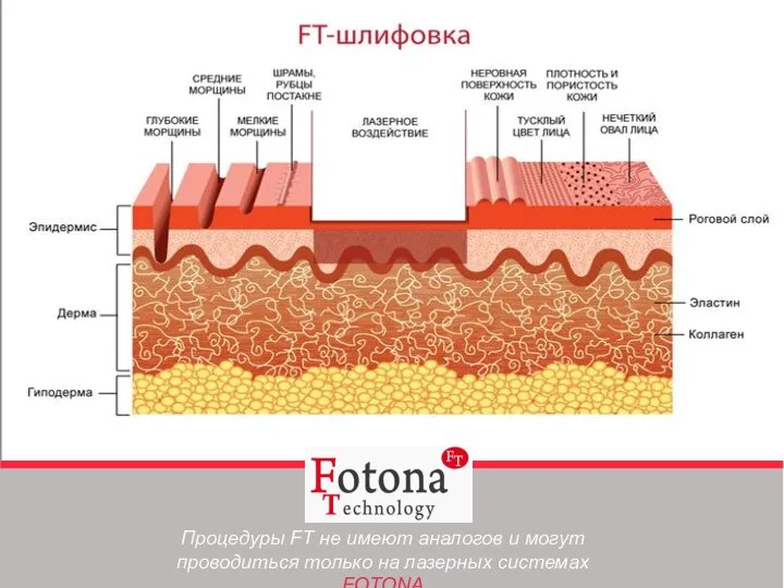 Процедуры FT не имеют аналогов и могут проводиться только на лазерных системах FOTONA