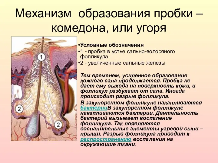 Механизм образования пробки – комедона, или угоря Условные обозначения 1 -