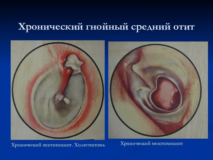 Хронический гнойный средний отит Хронический эпитимпанит. Холестеатома. Хронический мезотимпанит