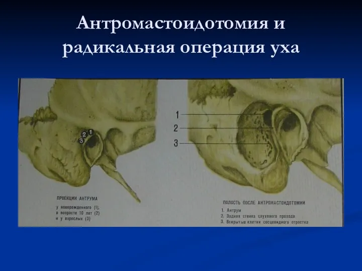 Антромастоидотомия и радикальная операция уха