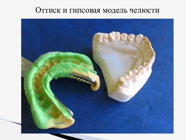 Оттиск и гипсовая модель челюсти