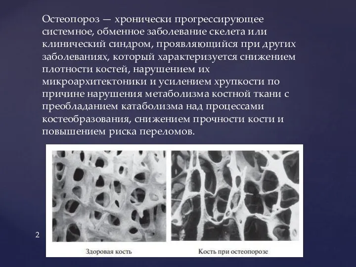 Остеопороз — хронически прогрессирующее системное, обменное заболевание скелета или клинический синдром,
