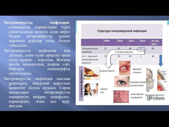 Энтеровирусты инфекция клиникалық көріністерін түрлі сипатталатын жеңіліс адам вирус Рудың энтеровирусты