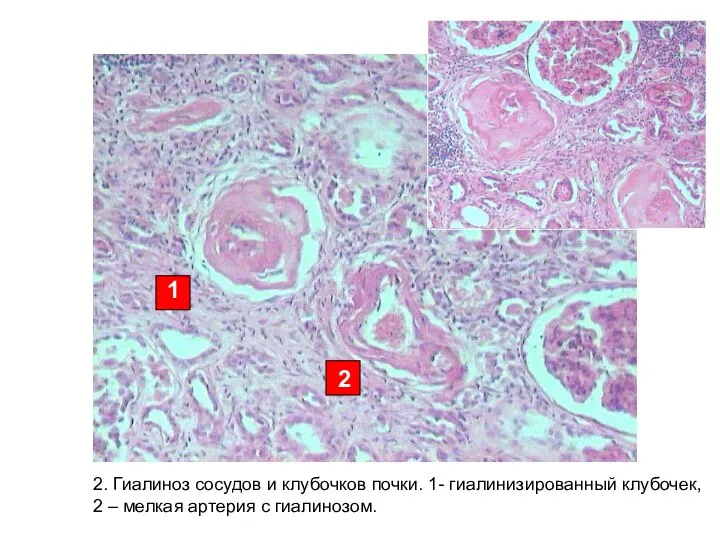 2. Гиалиноз сосудов и клубочков почки. 1- гиалинизированный клубочек, 2 –