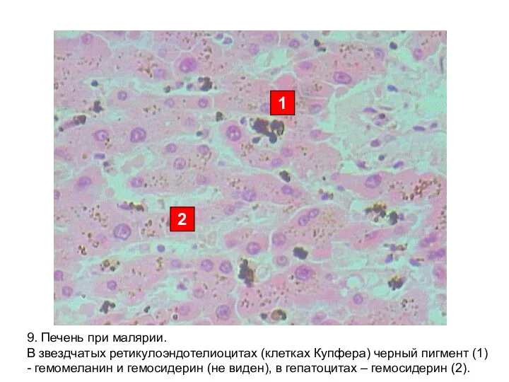 1 2 9. Печень при малярии. В звездчатых ретикулоэндотелиоцитах (клетках Купфера)