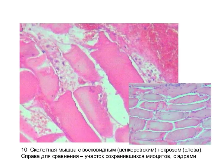 10. Скелетная мышца с восковидным (ценкеровским) некрозом (слева). Справа для сравнения