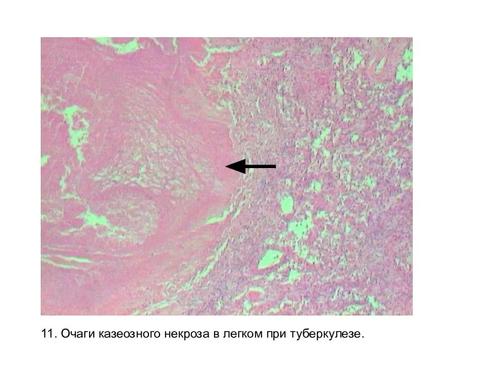 11. Очаги казеозного некроза в легком при туберкулезе.