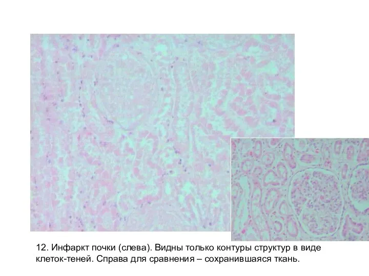 12. Инфаркт почки (слева). Видны только контуры структур в виде клеток-теней.