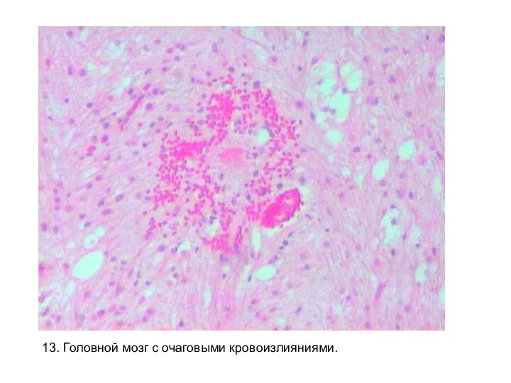 13. Головной мозг с очаговыми кровоизлияниями.