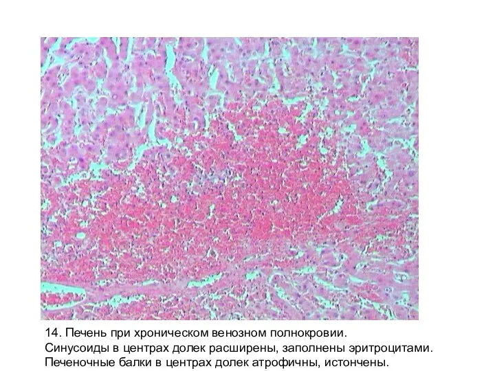 14. Печень при хроническом венозном полнокровии. Синусоиды в центрах долек расширены,