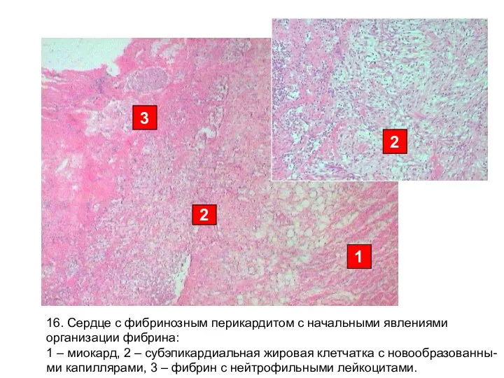16. Сердце с фибринозным перикардитом с начальными явлениями организации фибрина: 1