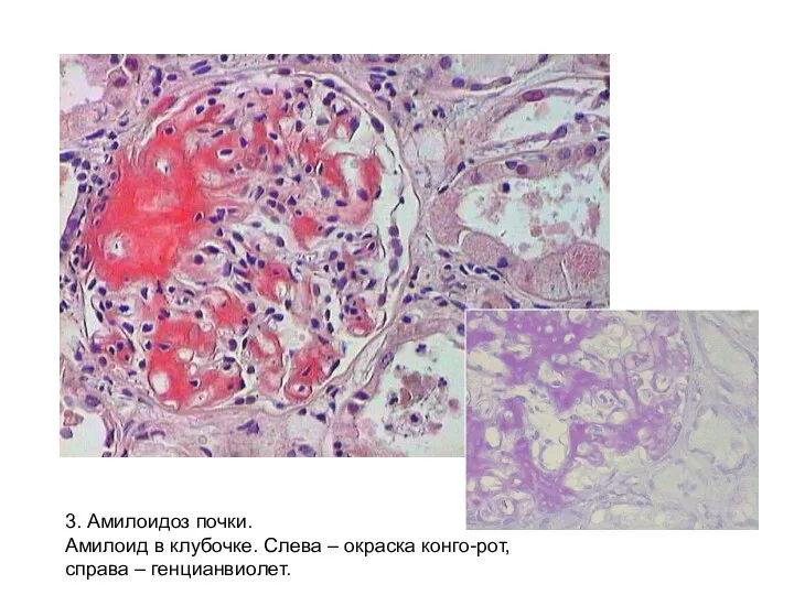 3. Амилоидоз почки. Амилоид в клубочке. Слева – окраска конго-рот, справа – генцианвиолет.