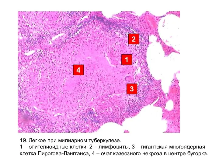 1 2 3 4 19. Легкое при милиарном туберкулезе. 1 –