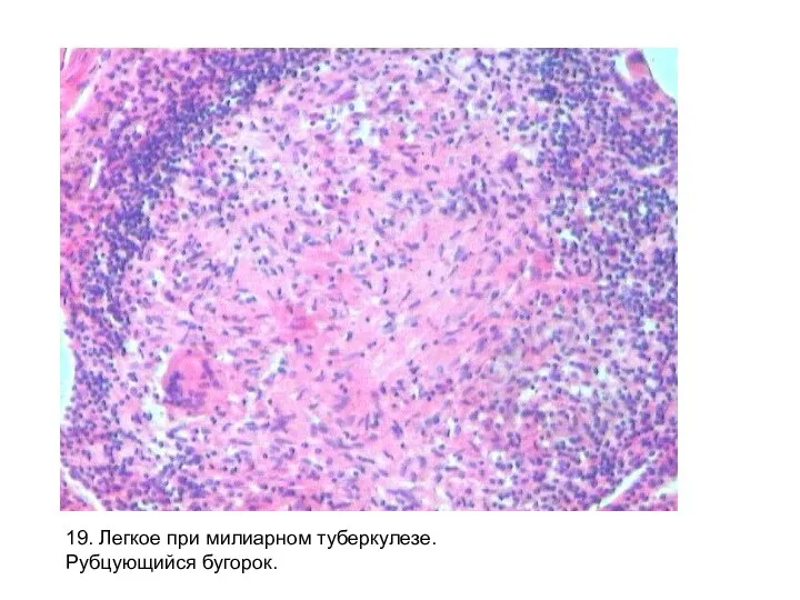 19. Легкое при милиарном туберкулезе. Рубцующийся бугорок.