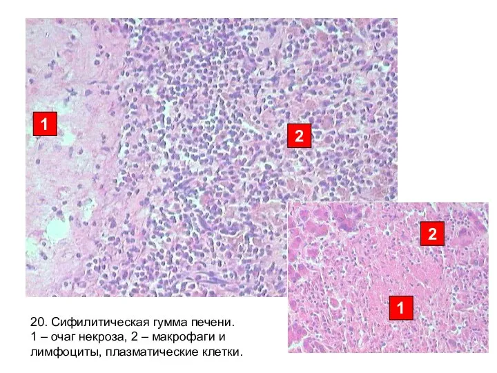 20. Сифилитическая гумма печени. 1 – очаг некроза, 2 – макрофаги