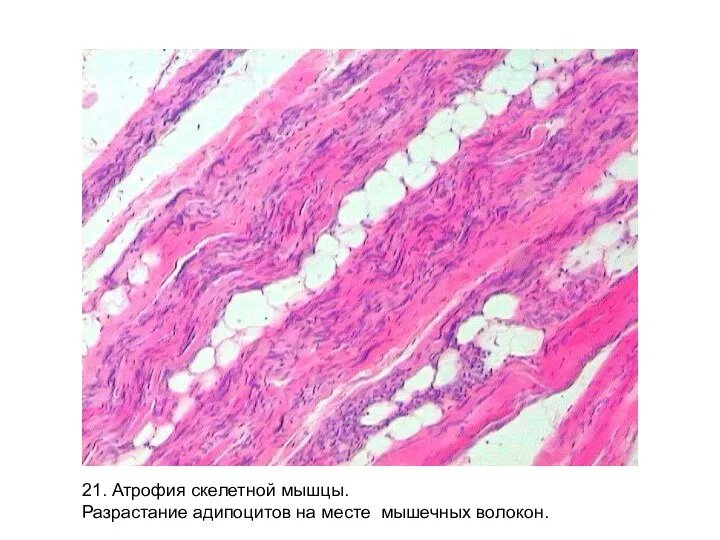 21. Атрофия скелетной мышцы. Разрастание адипоцитов на месте мышечных волокон.