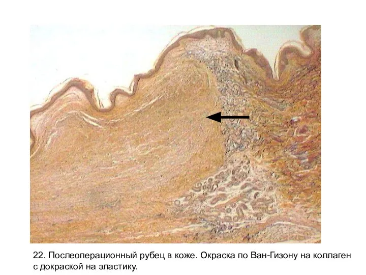 22. Послеоперационный рубец в коже. Окраска по Ван-Гизону на коллаген с докраской на эластику.