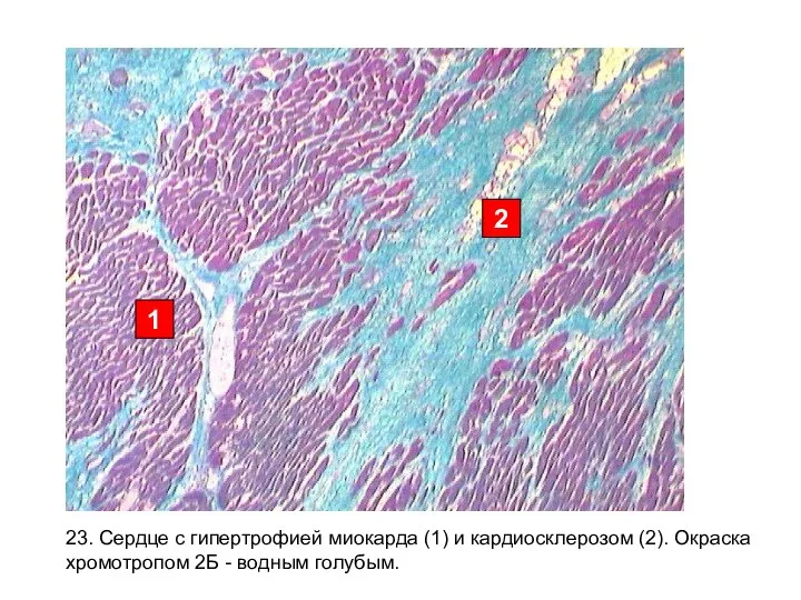 23. Сердце с гипертрофией миокарда (1) и кардиосклерозом (2). Окраска хромотропом