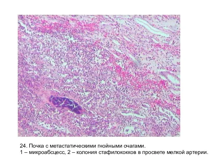 24. Почка с метастатическими гнойными очагами. 1 – микроабсцесс, 2 –