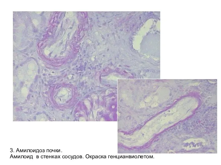 3. Амилоидоз почки. Амилоид в стенках сосудов. Окраска генцианвиолетом.