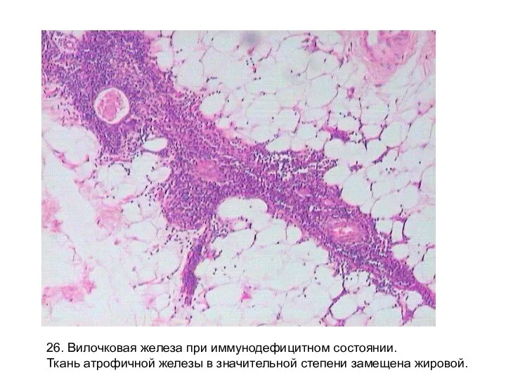26. Вилочковая железа при иммунодефицитном состоянии. Ткань атрофичной железы в значительной степени замещена жировой.