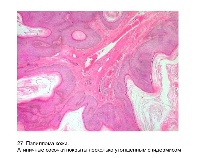 27. Папиллома кожи. Атипичные сосочки покрыты несколько утолщенным эпидермисом.