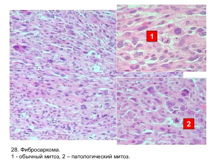 28. Фибросаркома. 1 - обычный митоз, 2 – патологический митоз. 2 1