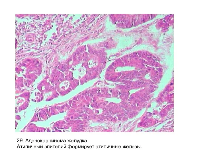 29. Аденокарцинома желудка. Атипичный эпителий формирует атипичные железы.