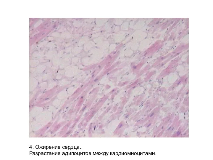 4. Ожирение сердца. Разрастание адипоцитов между кардиомиоцитами.