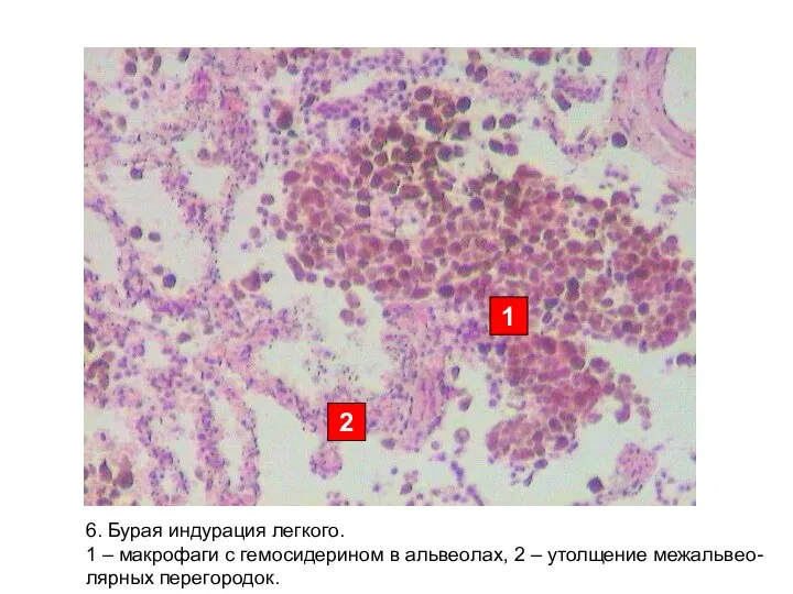 2 1 6. Бурая индурация легкого. 1 – макрофаги с гемосидерином