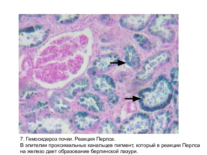 7. Гемосидероз почки. Реакция Перлса. В эпителии проксимальных канальцев пигмент, который