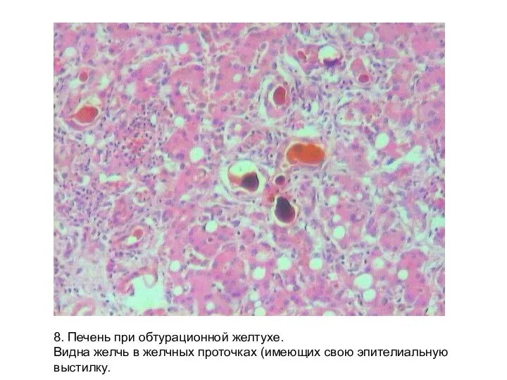 8. Печень при обтурационной желтухе. Видна желчь в желчных проточках (имеющих свою эпителиальную выстилку.