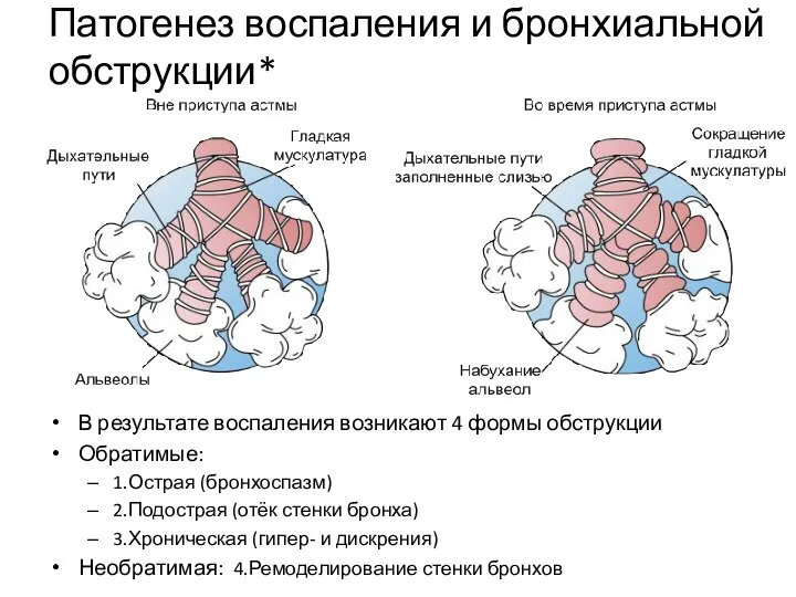 Патогенез воспаления и бронхиальной обструкции* В результате воспаления возникают 4 формы