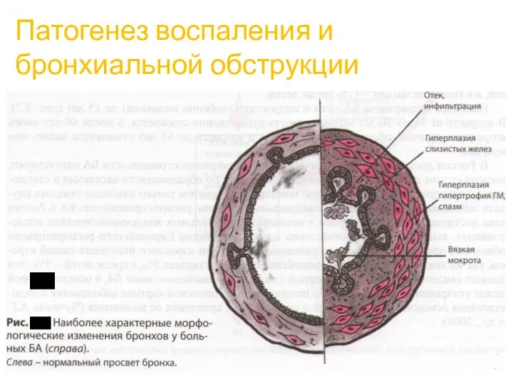 Патогенез воспаления и бронхиальной обструкции