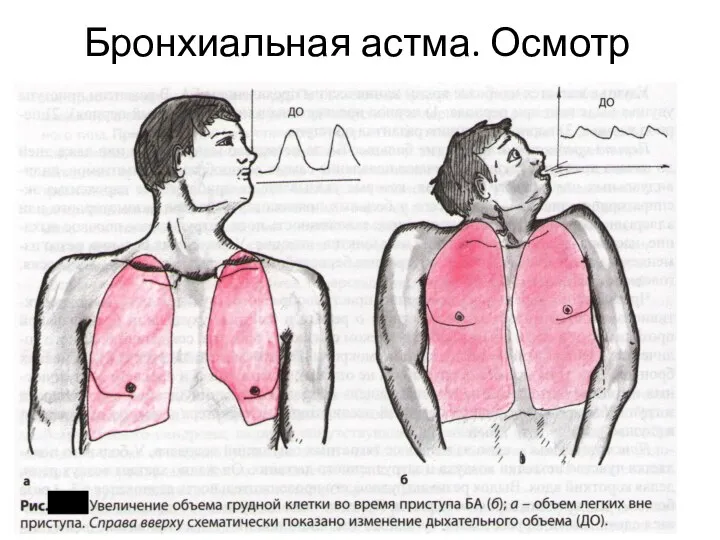 Бронхиальная астма. Осмотр