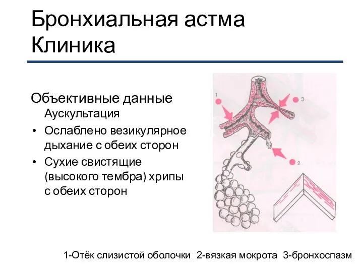 Бронхиальная астма Клиника Объективные данные Аускультация Ослаблено везикулярное дыхание с обеих