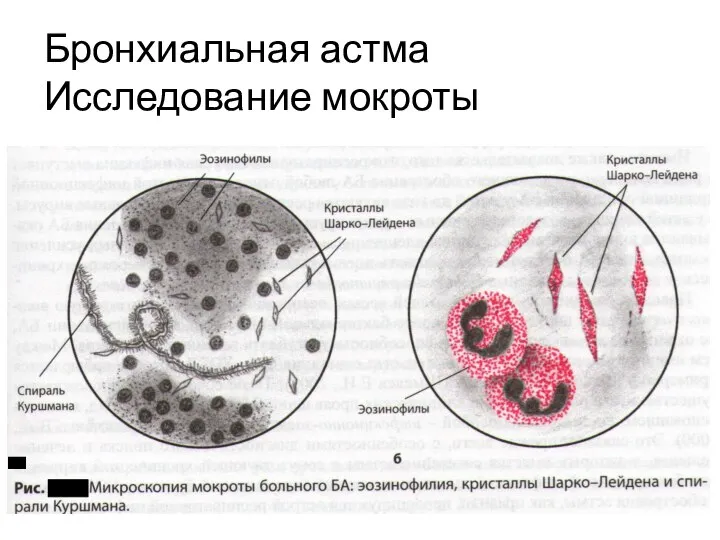 Бронхиальная астма Исследование мокроты