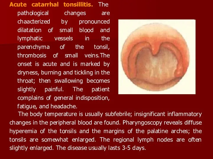 Acute catarrhal tonsillitis. The pathological changes are chaacterized by pronounced dilatation