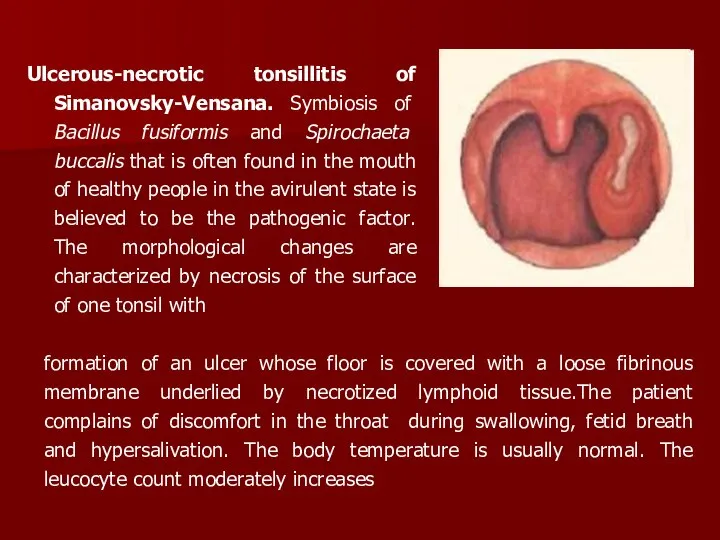 Ulcerous-necrotic tonsillitis of Simanovsky-Vensana. Symbiosis of Bacillus fusiformis and Spirochaeta buccalis