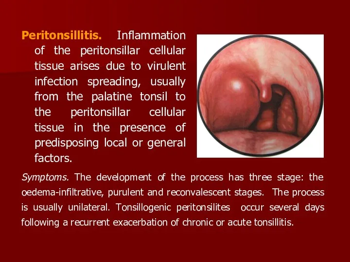 Peritonsillitis. Inflammation of the peritonsillar cellular tissue arises due to virulent