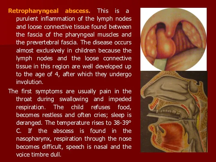 Retropharyngeal abscess. This is a purulent inflammation of the lymph nodes