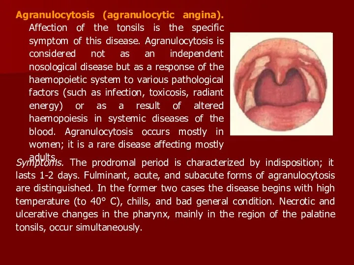 Agranulocytosis (agranulocytic angina). Affection of the tonsils is the specific symptom