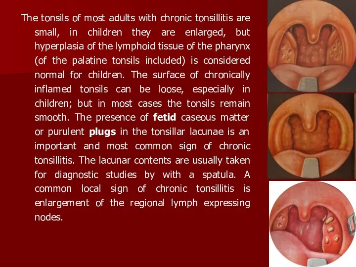 The tonsils of most adults with chronic tonsillitis are small, in
