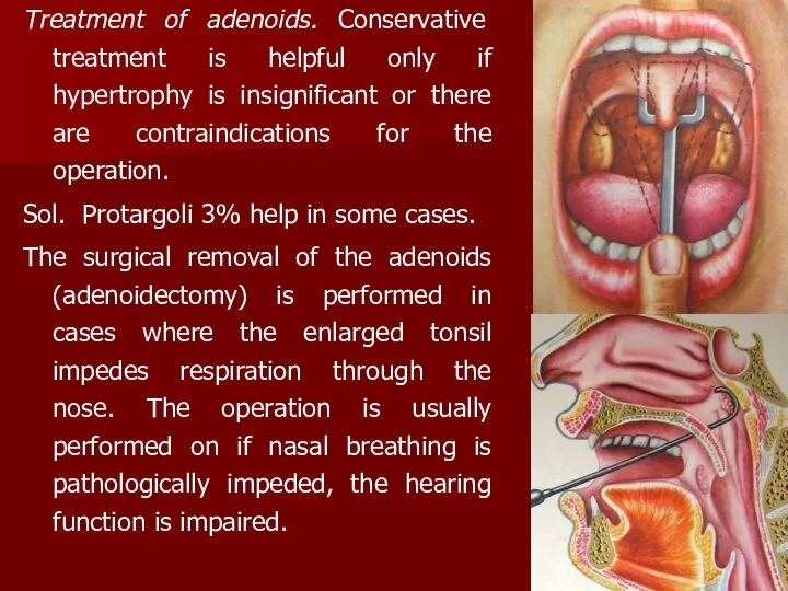 Treatment of adenoids. Conservative treatment is helpful only if hypertrophy is