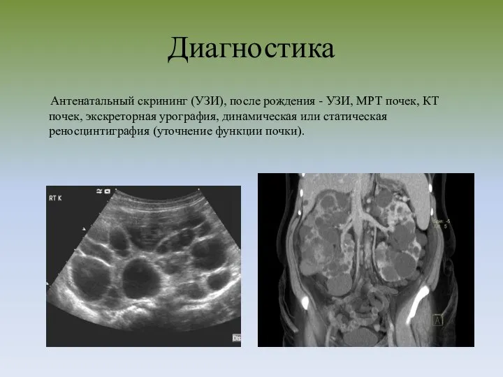 Диагностика Антенатальный скрининг (УЗИ), после рождения - УЗИ, МРТ почек, КТ