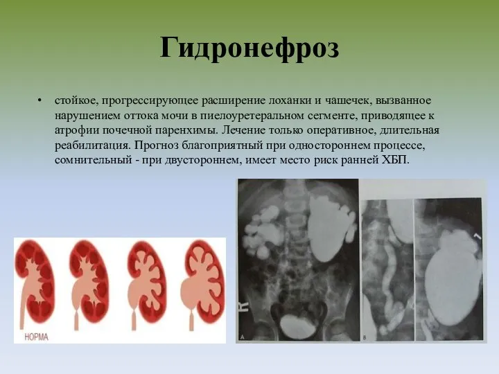 Гидронефроз стойкое, прогрессирующее расширение лоханки и чашечек, вызванное нарушением оттока мочи