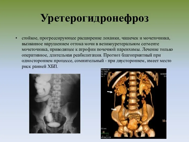 Уретерогидронефроз стойкое, прогрессирующее расширение лоханки, чашечек и мочеточника, вызванное нарушением оттока