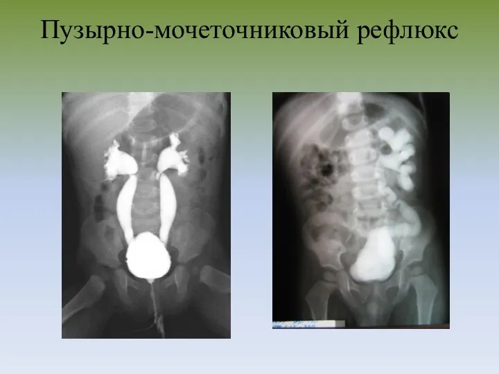 Пузырно-мочеточниковый рефлюкс