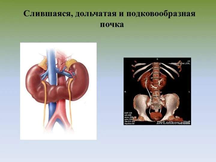 Слившаяся, дольчатая и подковообразная почка