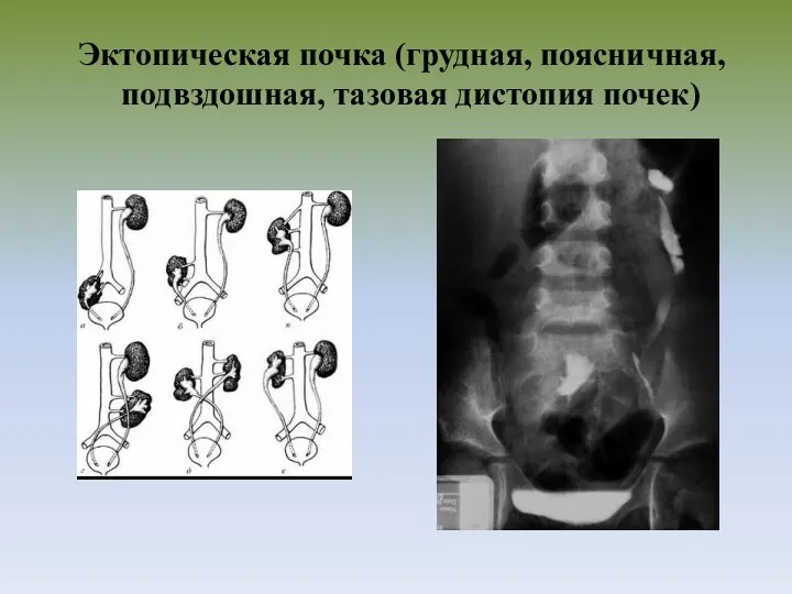 Эктопическая почка (грудная, поясничная, подвздошная, тазовая дистопия почек)